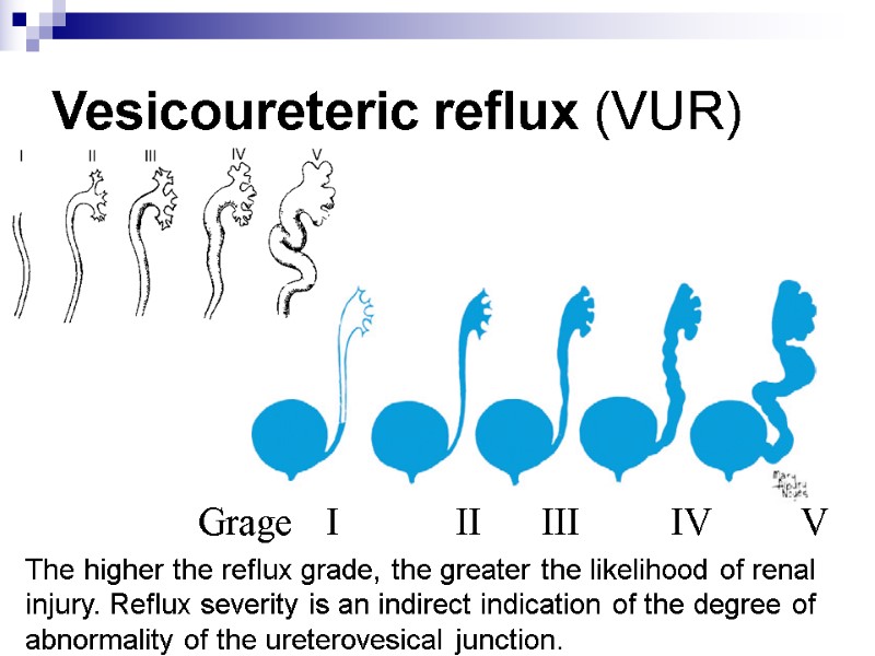 Vesicoureteric reflux (VUR)     Grage  I   II 